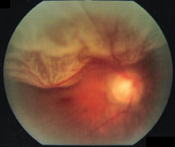 胞状の網膜剥離（視力0.01）